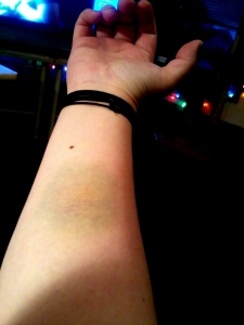 Bruise